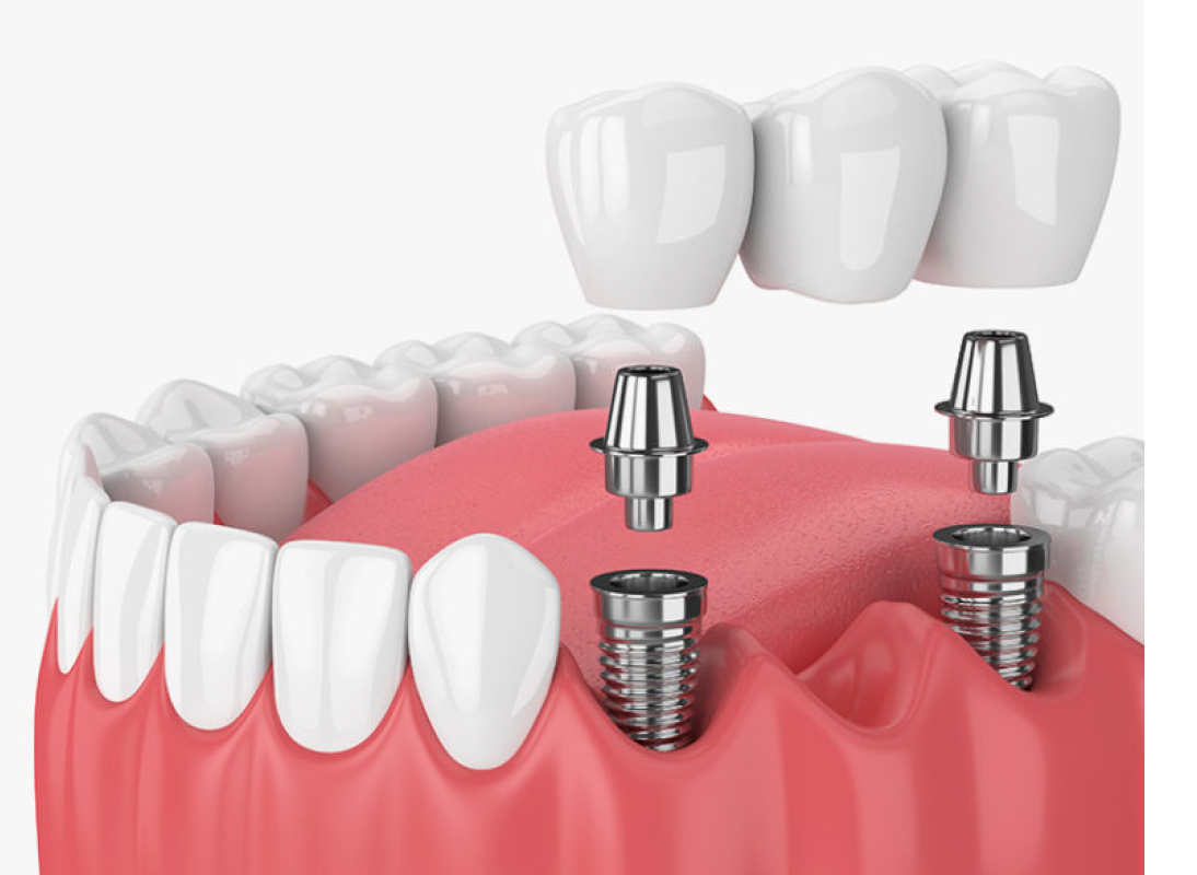 Dental Crowns