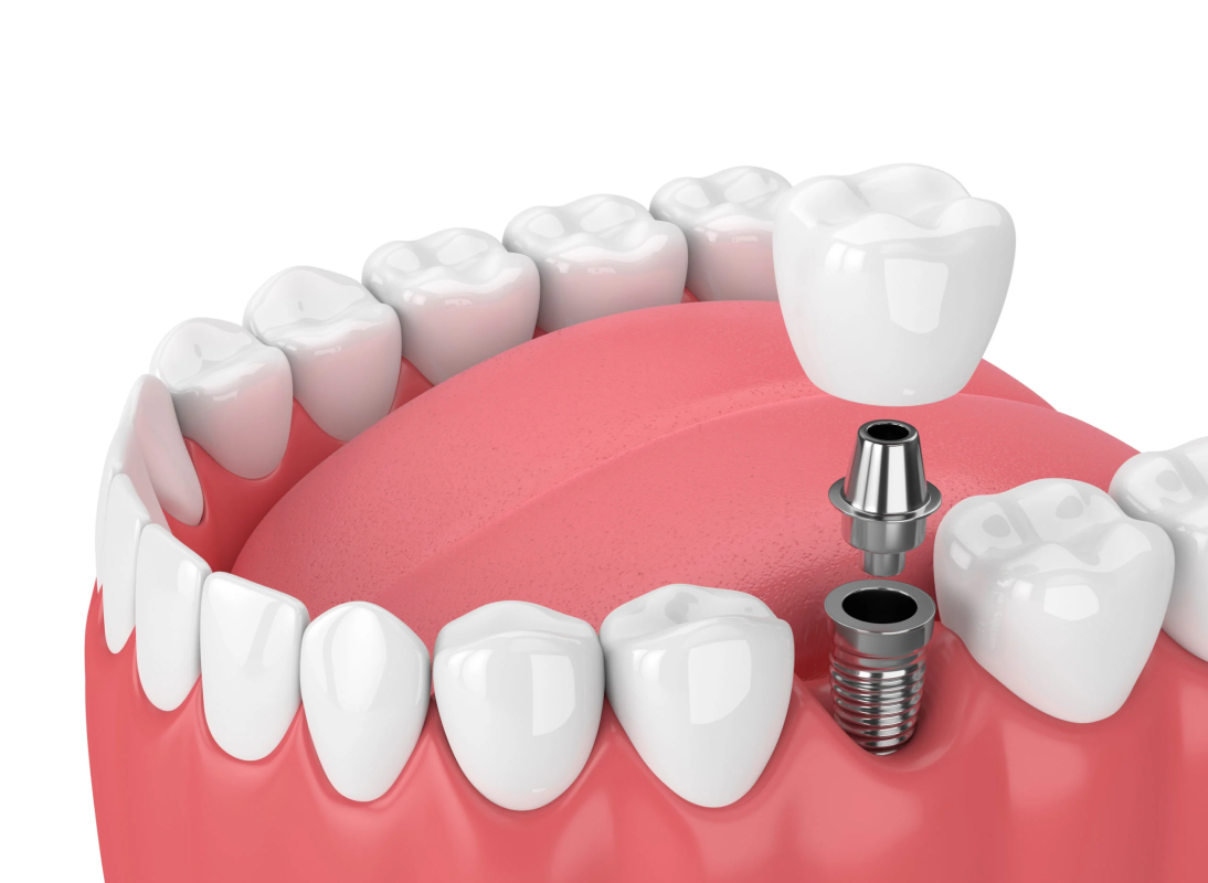 Dental Implants