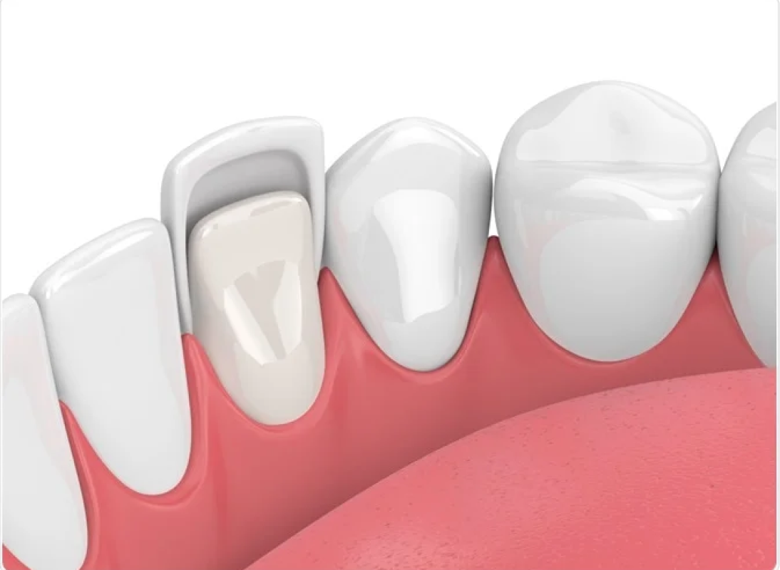 Dental Veneers