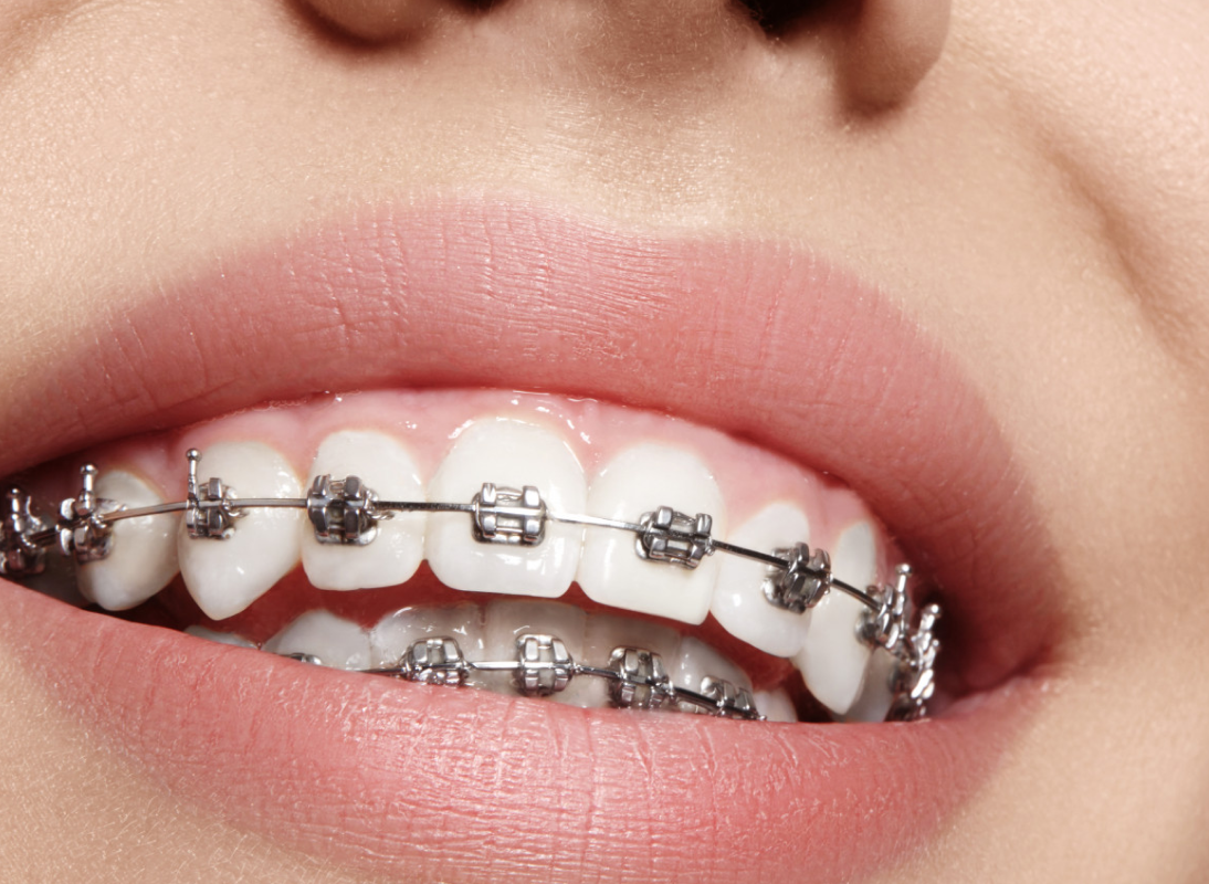 Orthodontic Treatment